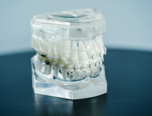 LightForce Clear Brackets – Our Orthodontists Offer Patients 3D Printed, Custom Braces
